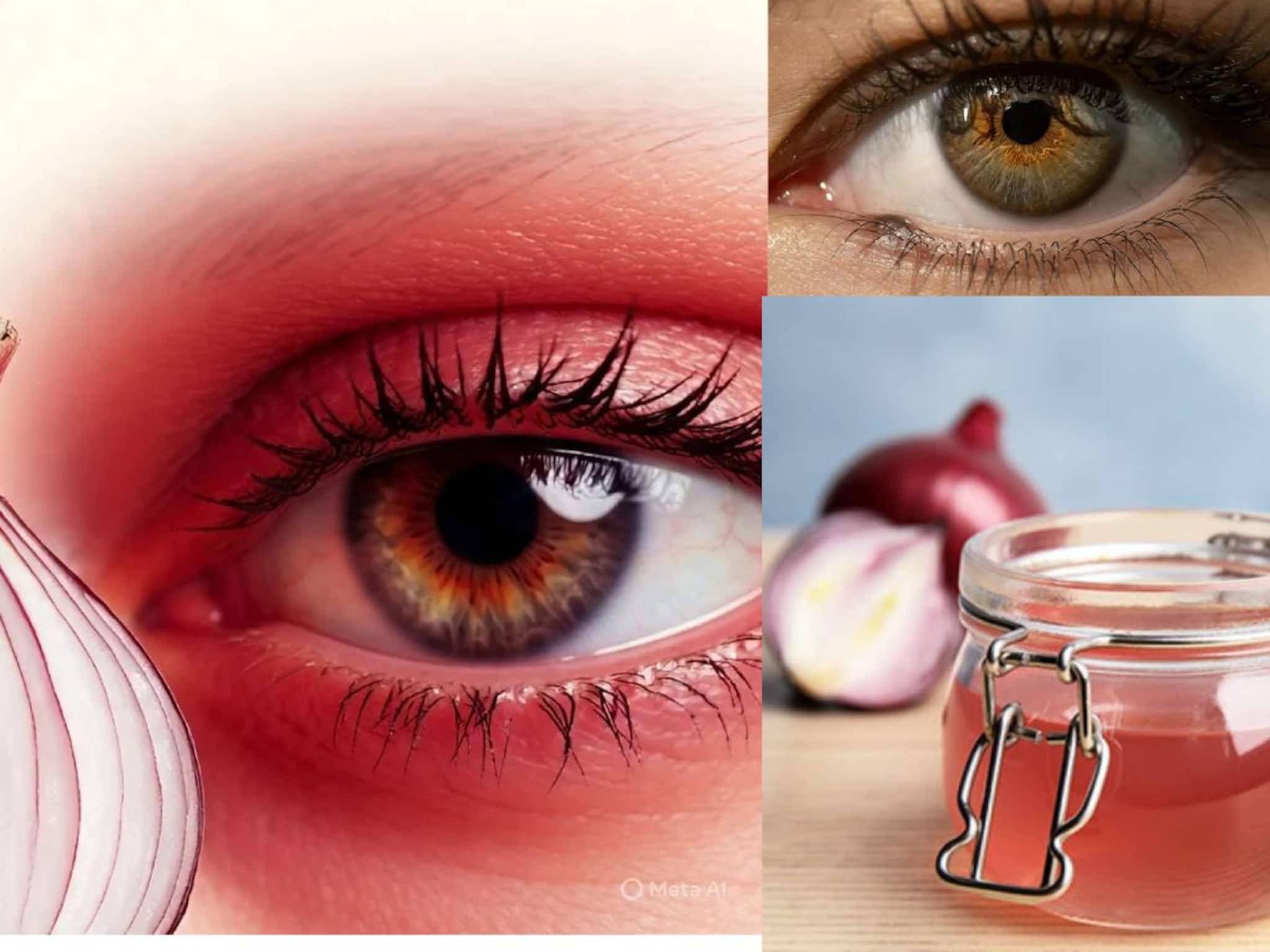 পেঁয়াজের রস দিচ্ছেন চোখে? সারবে কনজাঙ্কটিভাইটিস? নাকি হবে বড় ক্ষতি? জানুন বিশেষজ্ঞ-মত