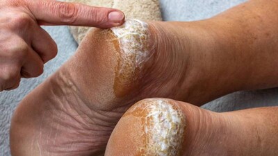  শীতকালে ফাটা গোড়ালি একটি সাধারণ সমস্যা যা অনেক লোককেই বিব্রত করে। বিশেষ করে ঠান্ডা আবহাওয়ায়, গোড়ালির ত্বক ফেটে যায়, যার ফলে ব্যথা, জ্বালা এবং অস্বস্তি হয়। তবে আপনার আর চিন্তা করার দরকার নেই, কারণ আমরা ফাটা জায়গাগুলির জন্য একটি সহজ এবং কার্যকর ঘরোয়া প্রতিকার শেয়ার করতে চলেছি।