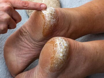 ১ টা ভাঙা মোমবাতিতে সারবে ফাটা গোড়ালি! ফুটিফাটা দূর হয়ে মোলায়েম হবে পা! রইল গোপন ট্রিকস