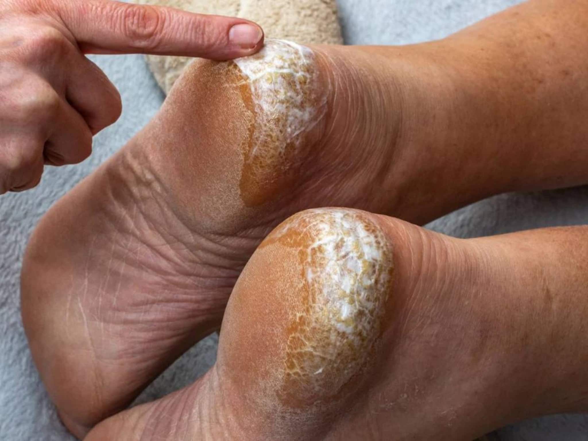 ১ টা ভাঙা মোমবাতিতে সারবে ফাটা গোড়ালি! ফুটিফাটা দূর হয়ে মোলায়েম হবে পা! রইল গোপন ট্রিকস