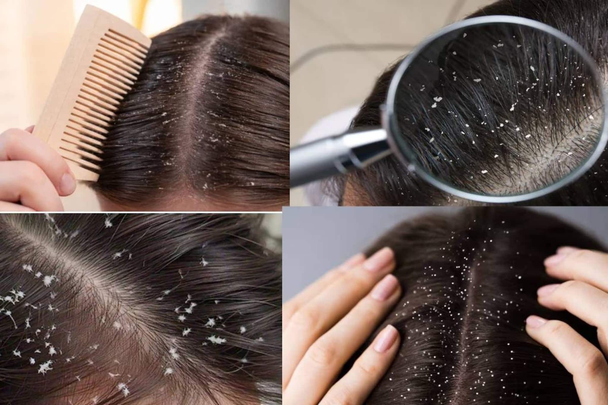 নারকেল তেল-লেবুর রসের কামাল! নির্বংশ খুশকি! শীতে চুলের হাজারো সমস্যার মুশকিল আসান! নারকেল তেল-লেবুর রসের কামাল! নির্বংশ খুশকি! শীতে চুলের হাজারো সমস্যার মুশকিল আসান!