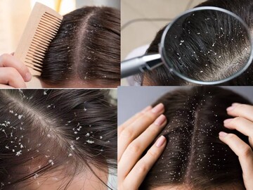 নারকেল তেল-লেবুর রসের কামাল! নির্বংশ খুশকি! শীতে চুলের হাজারো সমস্যার মুশকিল আসান!