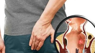 আয়ুর্বেদে পাইলসকে অর্শ রোগ বলা হয়