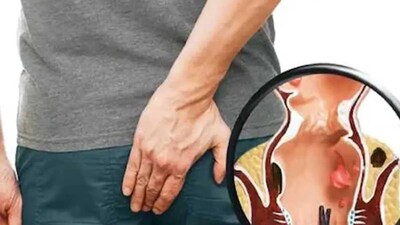 আয়ুর্বেদে পাইলসকে অর্শ রোগ বলা হয়