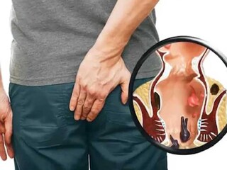 আয়ুর্বেদে পাইলসকে অর্শ রোগ বলা হয়