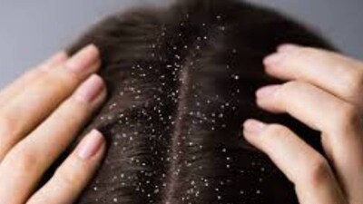 আর্দ্র আবহাওয়া এই ছত্রাককে উস্কে দিতে পারে, যার ফলে খুশকি হয়