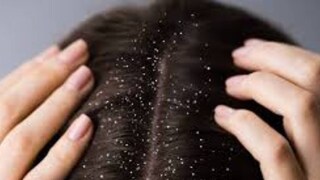 আর্দ্র আবহাওয়া এই ছত্রাককে উস্কে দিতে পারে, যার ফলে খুশকি হয়