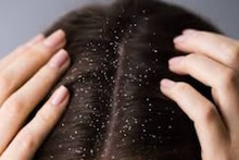 Dandruff Defeat: রোজ এই ছোট্ট কাজেই শীতে মাথা ভরে যায় খুশকিতে! সাবধান! আজই বন্ধ না হলে বারোটা বাজবে চুলের