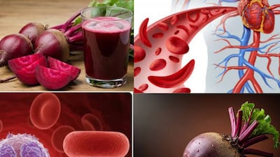 শিশু এবং মহিলাদের মধ্যে রক্তাল্পতা সবচেয়ে বেশি দেখা যায়। একটি সমীক্ষা অনুসারে, ভারতে প্রতি ৪ জনের মধ্যে ৩ জন মহিলা পর্যাপ্ত পরিমাণে আয়রন গ্রহণ করেন না। আয়রনের ঘাটতির লক্ষণগুলি প্রায়শই হালকা থাকে। রক্তাল্পতায় ভুগছেন এমন ব্যক্তিদের প্রায়শই বিট খাওয়ার পরামর্শ দেওয়া হয় যদি তারা রক্তাল্পতার সমস্যায় ভোগেন। কিন্তু শুধুমাত্র বিট কি রক্তাল্পতার সঙ্গে সম্পর্কিত সমস্যাগুলি নিয়ন্ত্রণ করতে পারে? আসুন একজন বিশেষজ্ঞের কাছ থেকে জেনে নেওয়া যাক। বিশিষ্ট পুষ্টিবিদ প্রাচী জৈন বলেন, এই ধারণা সম্পূর্ণ ভুল। বিট স্বাস্থ্যের জন্য ভাল হলেও, এটিকে রক্তাল্পতার নিরাময় হিসেবে বিবেচনা করা ভুল ধারণা।