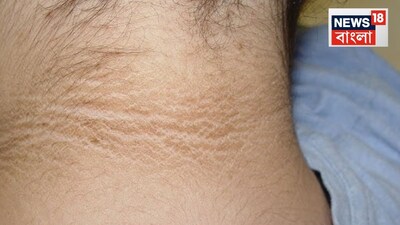 Dark Neck Patches Signal More Than Dirt: Doctors Warn of Hidden Health Risks