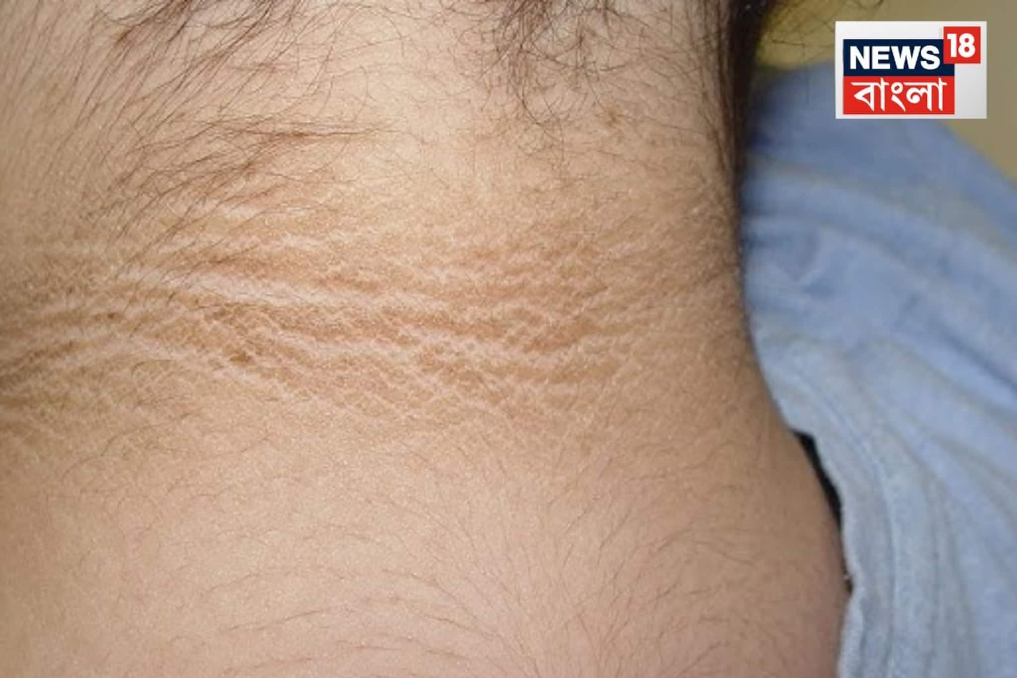 গলার কালো দাগ মানেই ময়লা নয়, অজান্তেই শরীরের ভেতরে কী হচ্ছে জানেন? সতর্ক হতে বলছেন চিকিৎসক