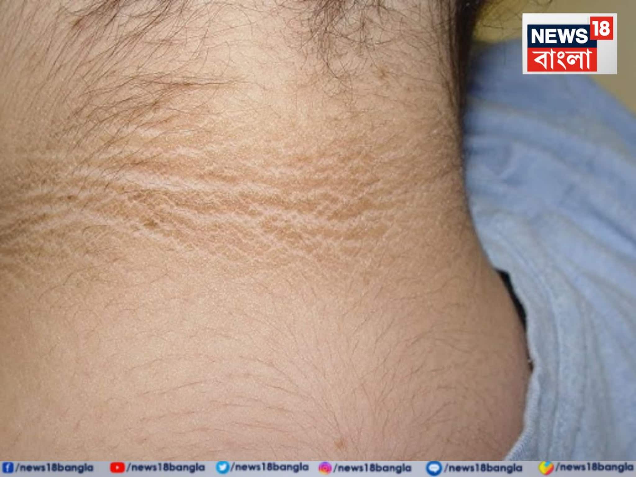 গলার কালো দাগ মানেই ময়লা নয়, অজান্তেই শরীরের ভেতরে কী হচ্ছে জানেন? সতর্ক হতে বলছেন চিকিৎসক