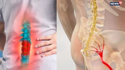 स्लिप डिस्क बनाम कटिस्नायुशूल: डॉक्टर ने बताया अंतर, उपचार और कारण.