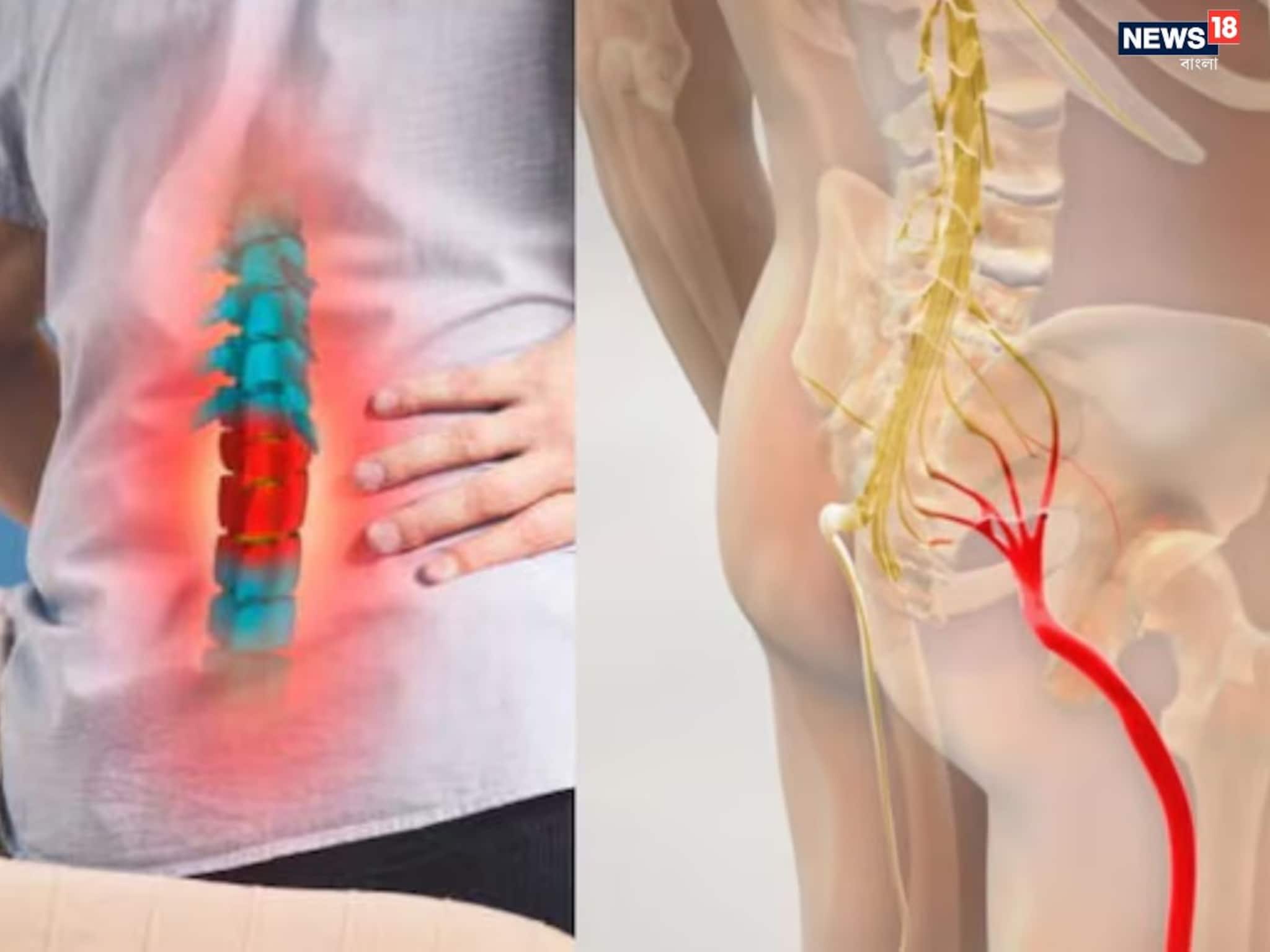 Difference between Slip Disc vs Sciatica: দীর্ঘদিনের ব্যথার কারণ কী? স্লিপ ডিস্ক ও সায়াটিকার ফারাক বুঝিয়ে দিলেন চিকিৎসক