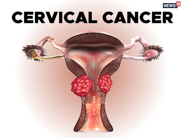 নীরবে শরীরে বাসা বাঁধে HPV, বছর পরে ডেকে আনে সার্ভিক্যাল ক্যানসার সতর্ক করছেন বিশেষজ্ঞরা