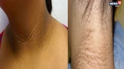 স্বাস্থ্য বিশেষজ্ঞদের মতে, সবচেয়ে সাধারণ কারণগুলোর মধ্যে রয়েছে ইনসুলিন প্রতিরোধক্ষমতা (insulin resistance) — যেখানে শরীর গ্লুকোজ নিয়ন্ত্রণে ইনসুলিনকে ঠিকভাবে ব্যবহার করতে পারে না এবং ফলস্বরূপ রক্তে উচ্চ ইনসুলিনের মাত্রা থেকে এই ত্বক পরিবর্তন দেখা যায়। এটি আগে থেকেই ডায়াবেটিস বা টাইপ-২ ডায়াবেটিসের ঝুঁকির শুরুর বার্তা হিসেবেও বিবেচিত হয়।