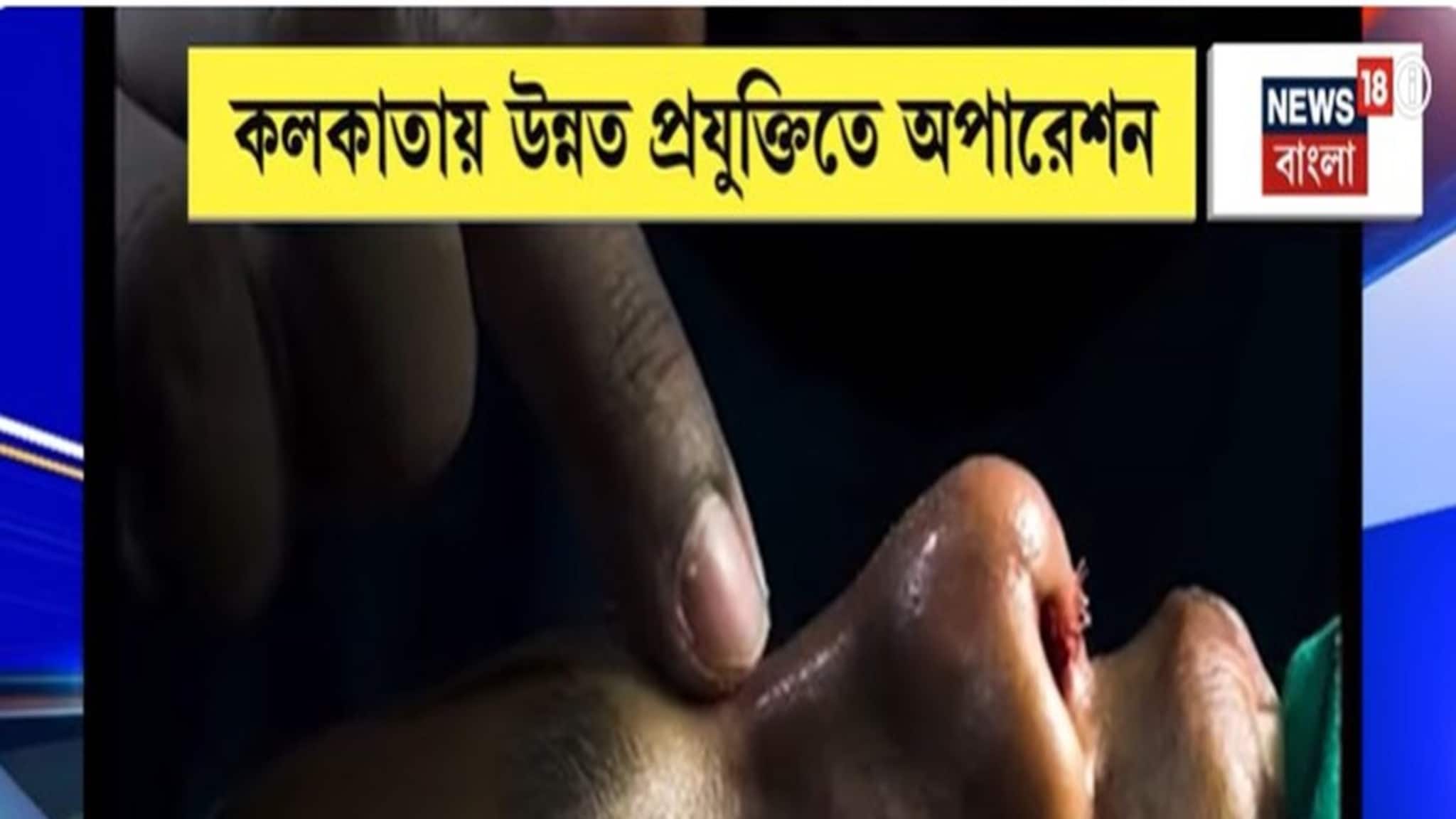 Nose Surgery: নাক নিয়ে খুঁত খুঁত? এবার কলকাতায় রক্তপাত ছাড়াই নাক নিখুঁত করুন
