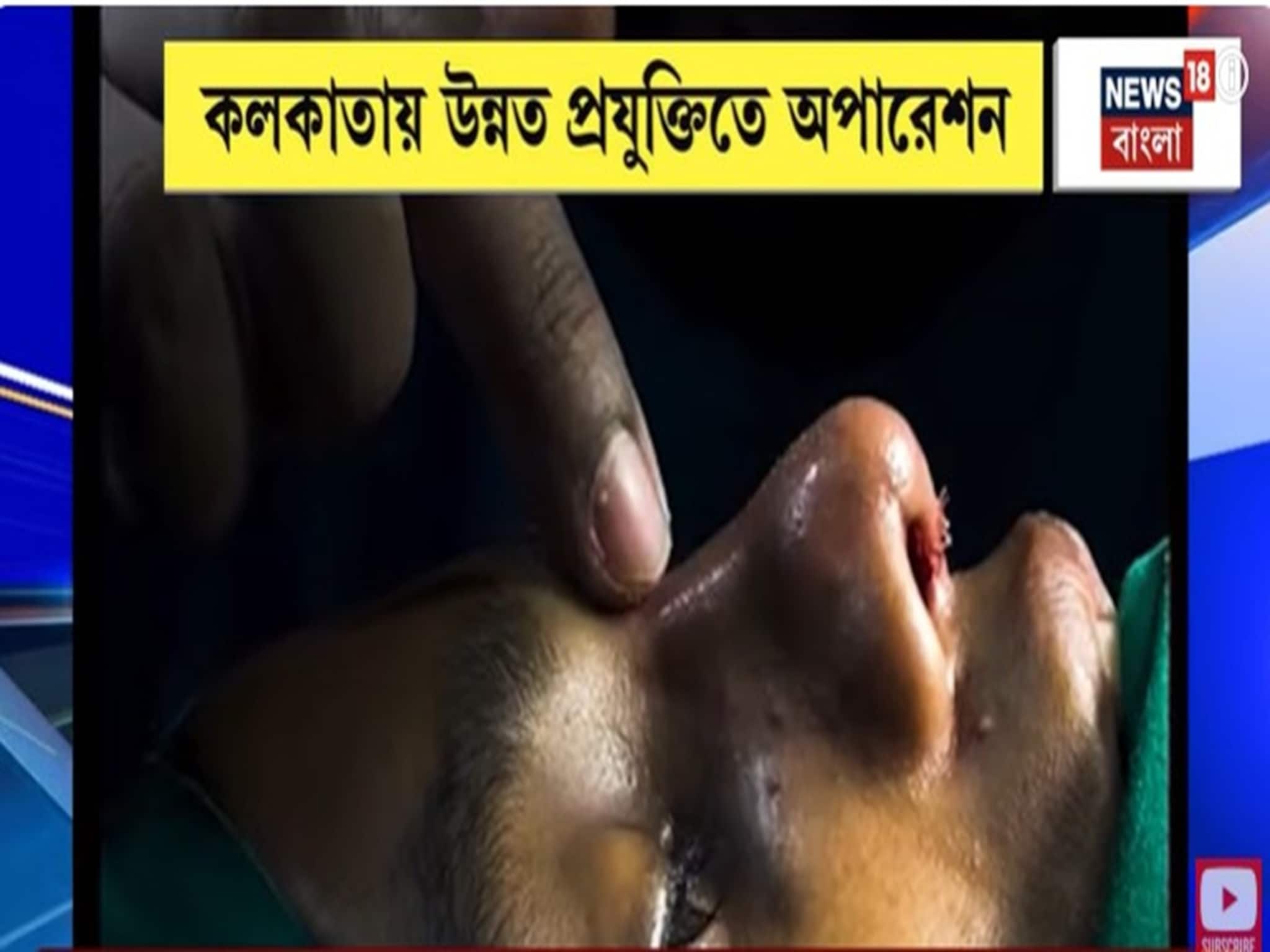 নাক নিয়ে খুঁত খুঁত? এবার রক্তপাত ছাড়াই নাক নিখুঁত করুন নাক নিয়ে খুঁত খুঁত? এবার রক্তপাত ছাড়াই নাক নিখুঁত করুন