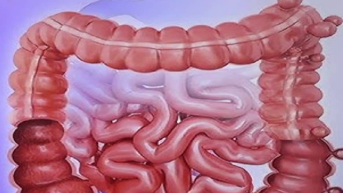 Crohn's Disease Vs Ulcerative Colitis: ক্রোনস ডিজিজ ও আলসারেটিভ ...