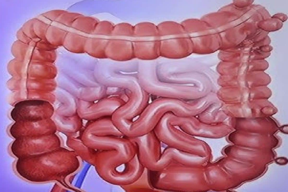 ক্রোনস ডিজিজ ও আলসারেটিভ কোলাইটিস—দুটি আলাদা রোগে এত মিল কেন? বুঝিয়ে বললেন চিকিৎসক