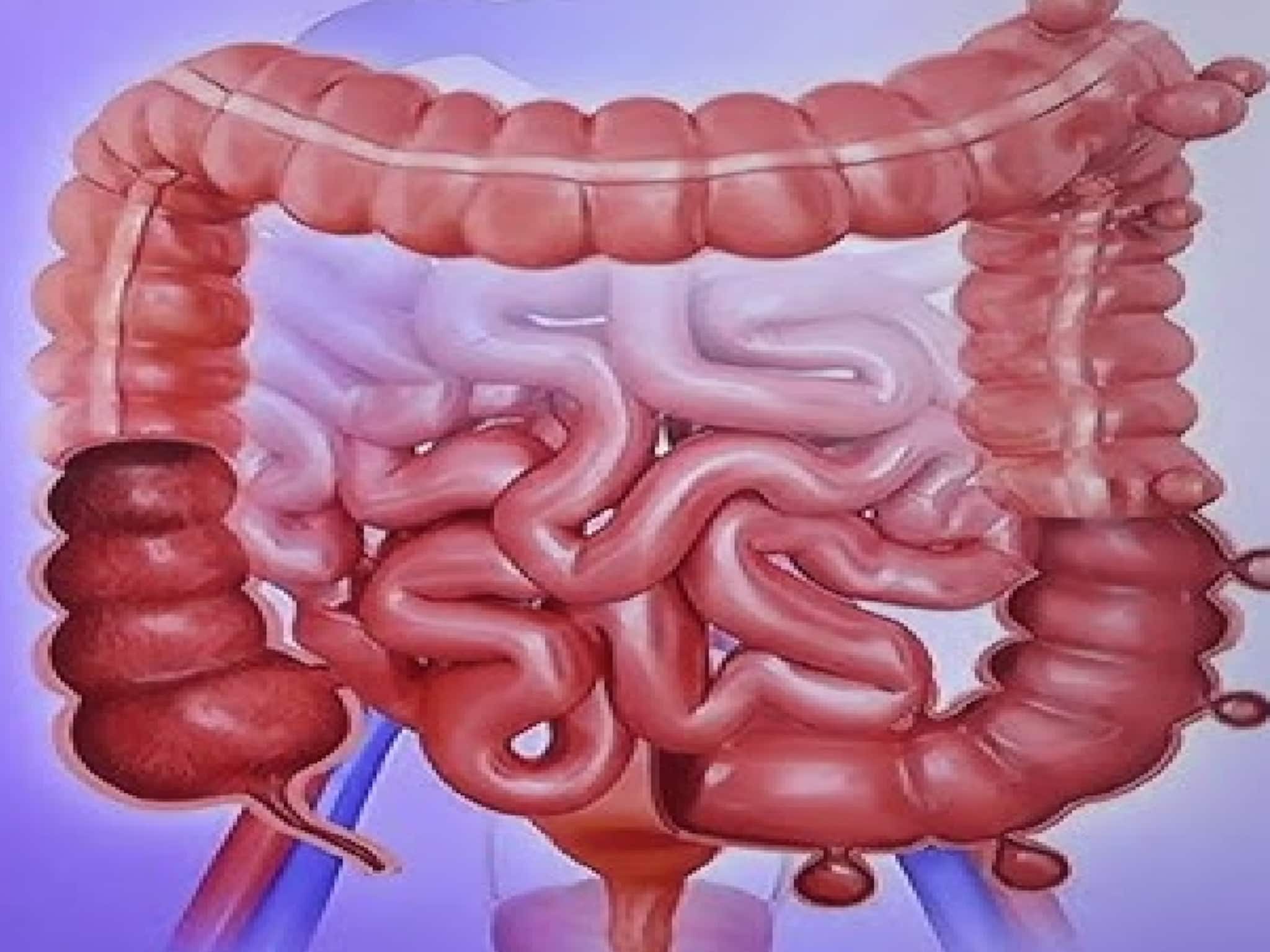 ক্রোনস ডিজিজ ও আলসারেটিভ কোলাইটিস—দুটি আলাদা রোগে এত মিল কেন? বুঝিয়ে বললেন চিকিৎসক