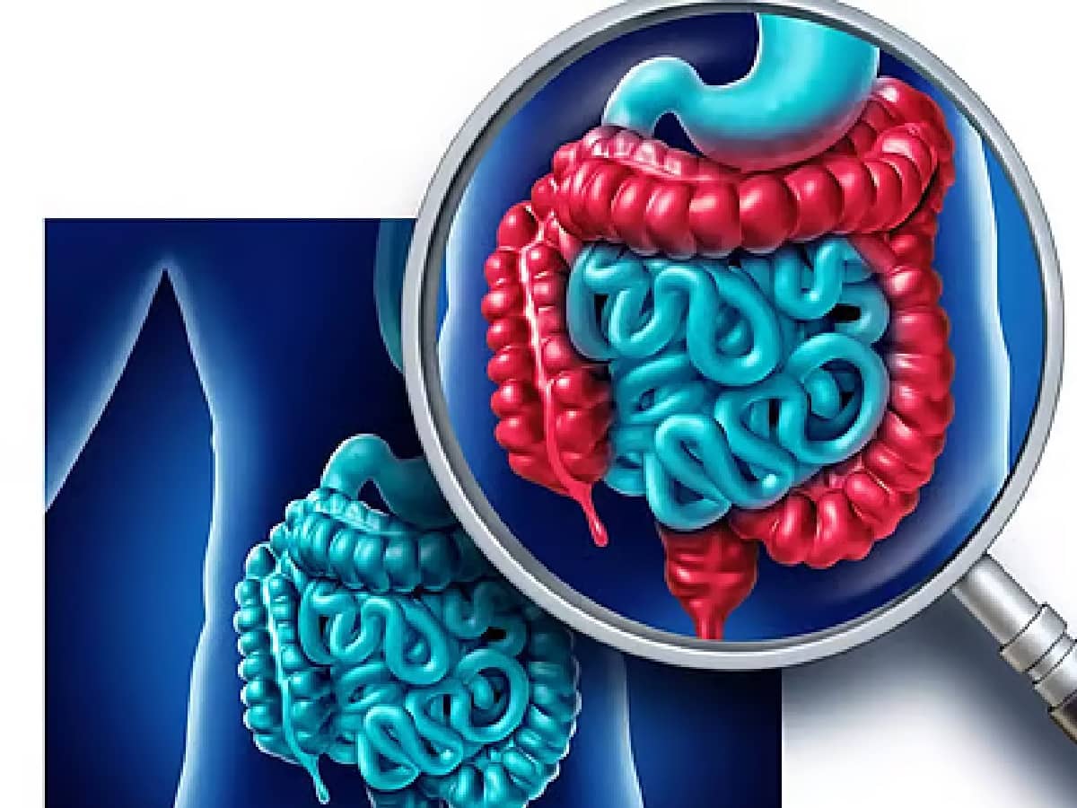 Crohns Disease Vs Ulcerative Colitis: 