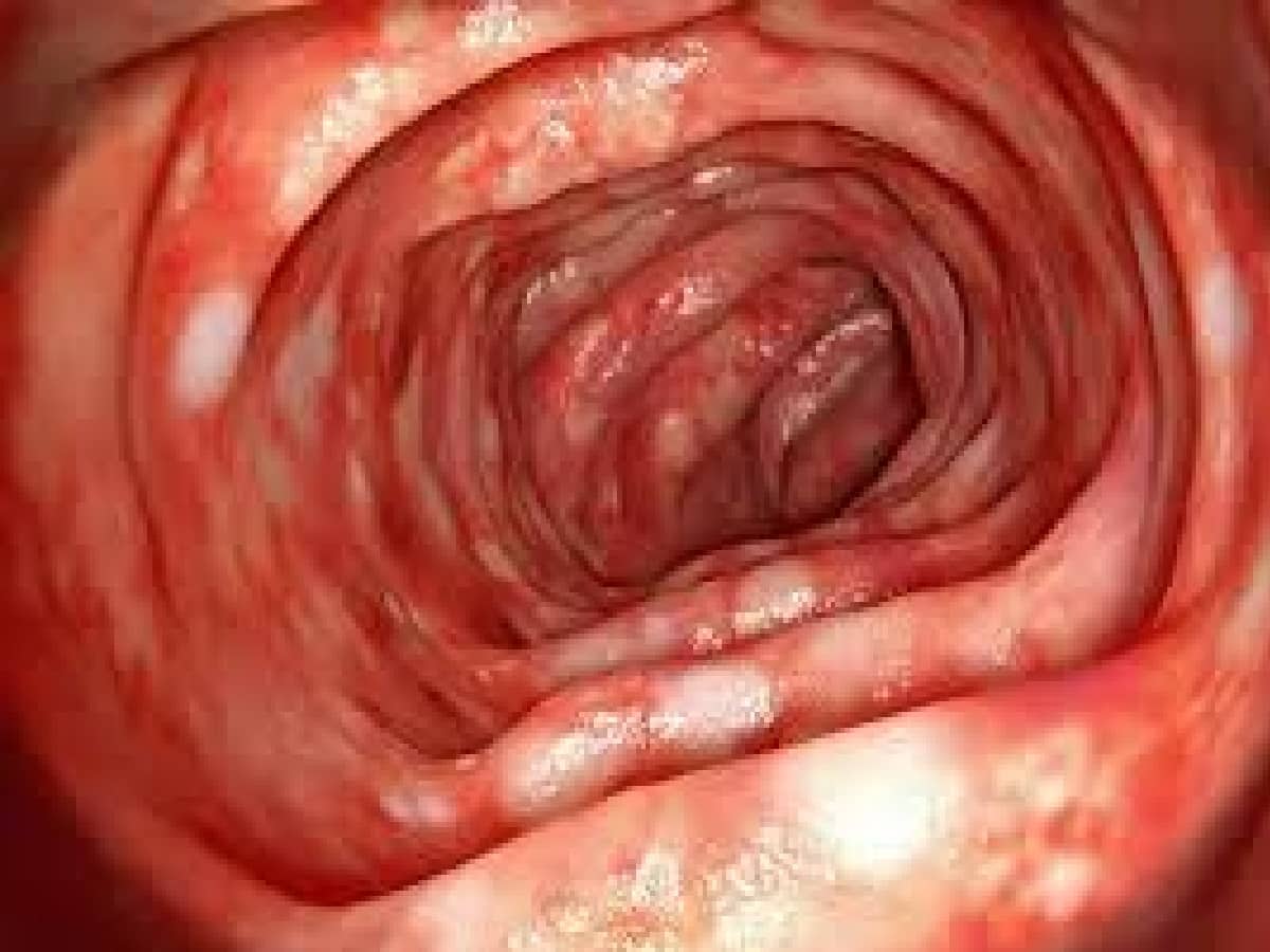 ক্রোনস ডিজিজ ও আলসারেটিভ কোলাইটিস: কোথায় মিল, কোথায় অমিল? জানাচ্ছেন চিকিৎসক Crohns Disease Vs Ulcerative Colitis: 