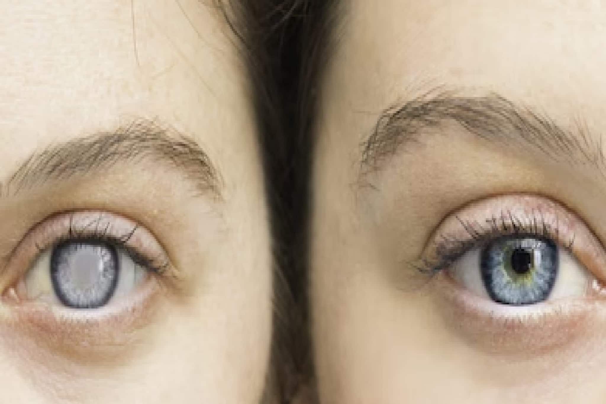 তরুণ বয়সেও গ্লুকোমার ভয়! আগেভাগে ধরা পড়লেই বাঁচতে পারে দৃষ্টিশক্তি, চিনুন লক্ষণ!