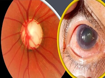 তরুণ বয়সেও গ্লুকোমার ভয়! আগেভাগে ধরা পড়লেই বাঁচতে পারে দৃষ্টিশক্তি, চিনুন লক্ষণ!