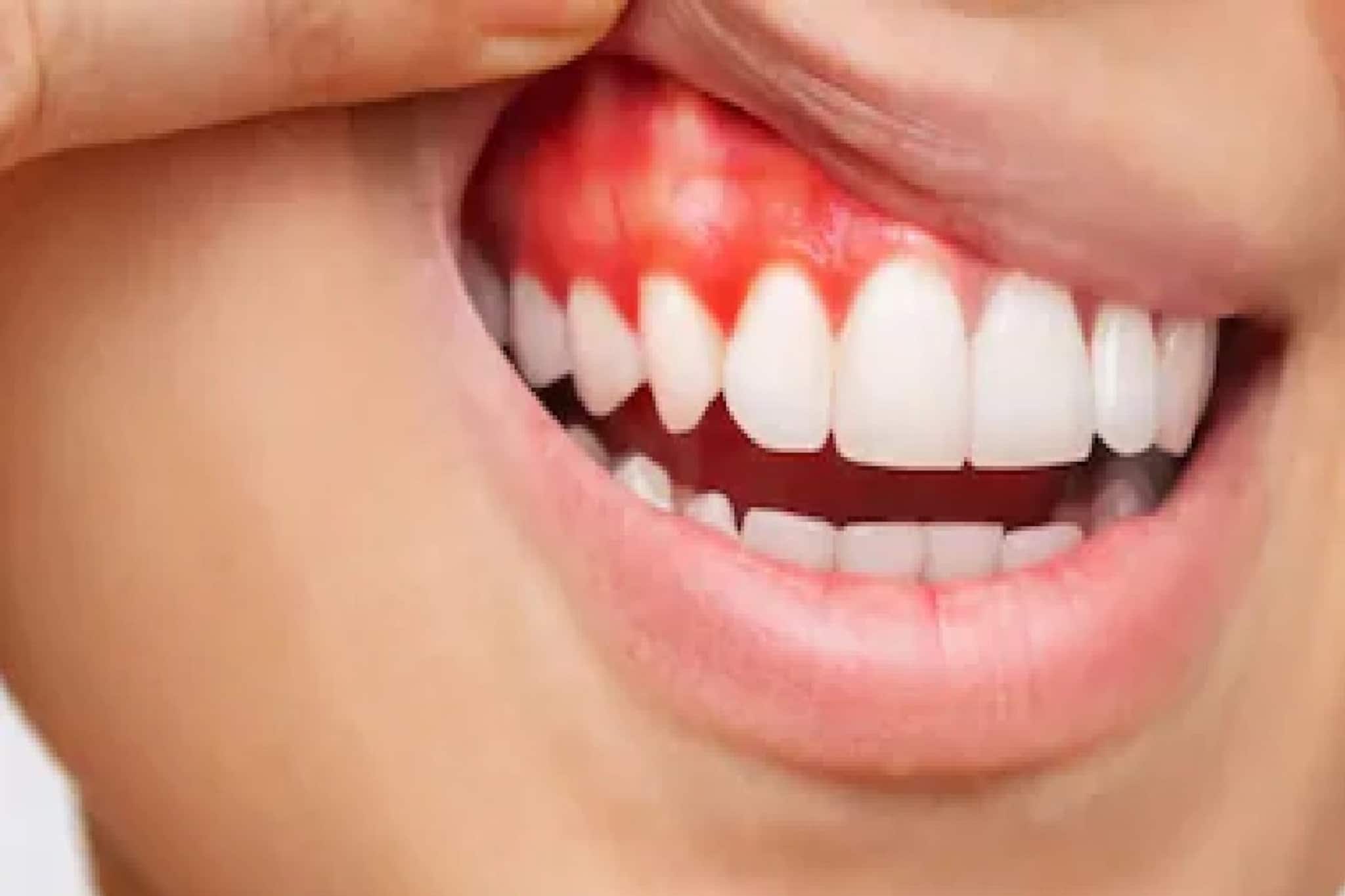 ব্রাশ করলেই মাড়ি থেকে রক্ত পড়ে? সতর্ক সংকেত...! শরীরে বাসা বেঁধেছে কোন রোগ? অবহেলা নয়!