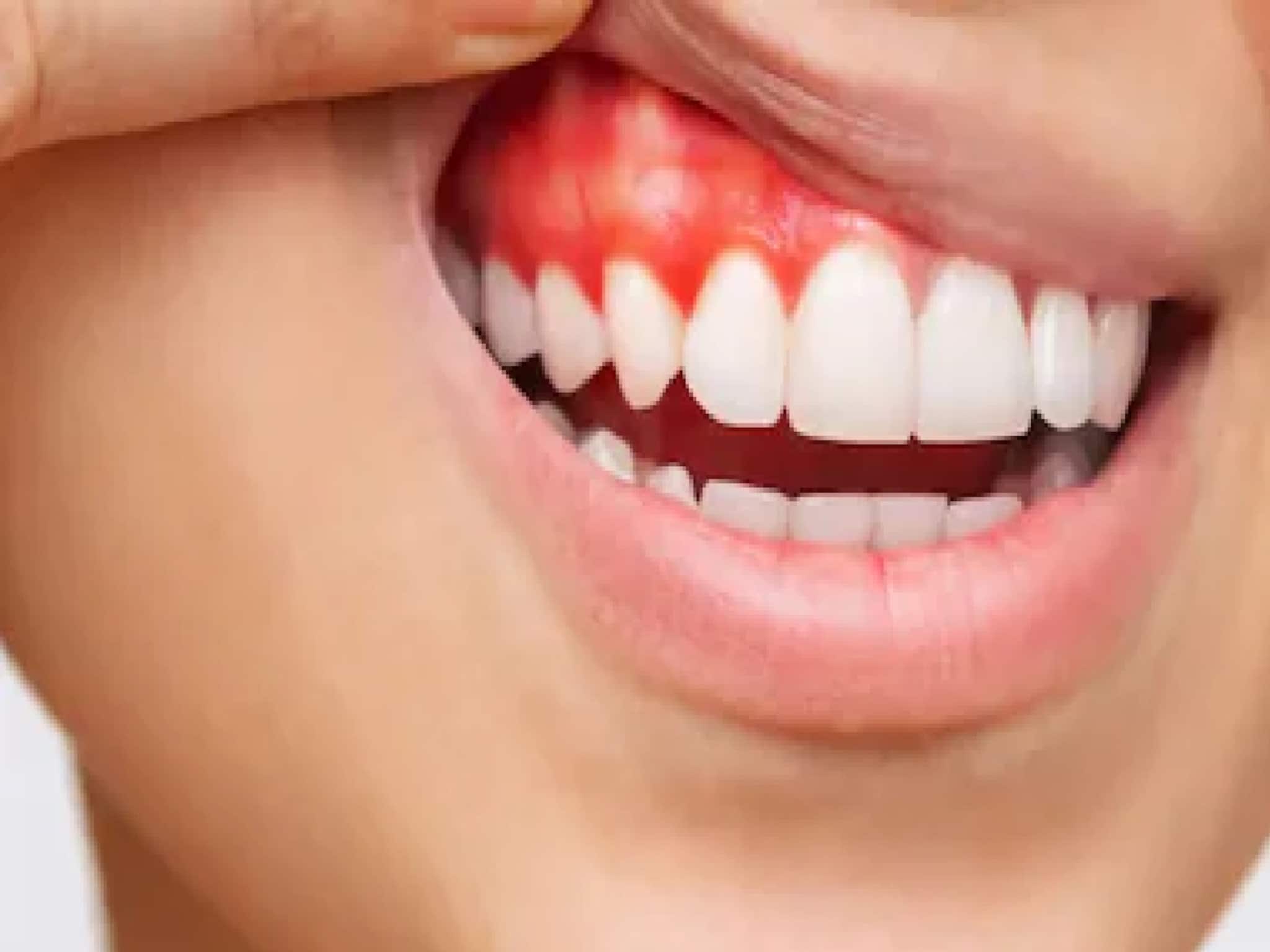 ব্রাশ করলেই মাড়ি থেকে রক্ত পড়ে? সতর্ক সংকেত...! শরীরে বাসা বেঁধেছে কোন রোগ? অবহেলা নয়!