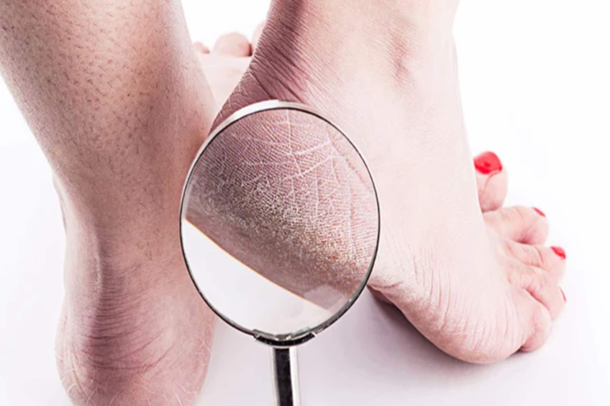 গোড়ালি ফেটে চৌচির...? রাতে নারকেল তেলে মিশিয়ে লাগান ছোট্ট দুই 'জিনিস', সকালেই দেখুন তফাৎ