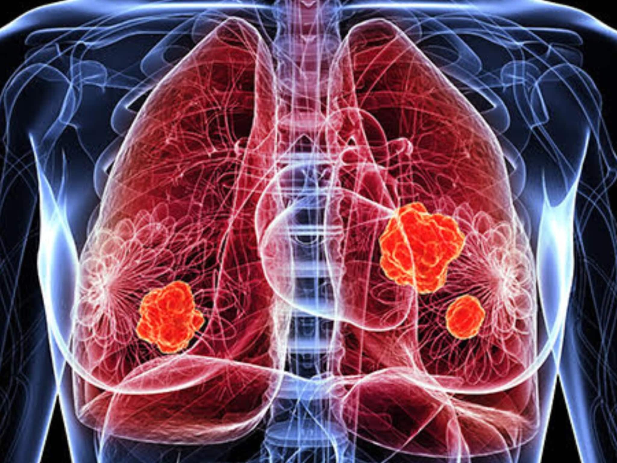 কাশি সারছে না? গলার স্বর ভাঙা? সাবধান! ফুসফুসের ক্যানসারের যে ১০ উপসর্গ আমরা এড়িয়ে যাই কাশি সারছে না? গলার স্বর ভাঙা? সাবধান! ফুসফুসের ক্যানসারের যে ১০ উপসর্গ আমরা এড়িয়ে যাই