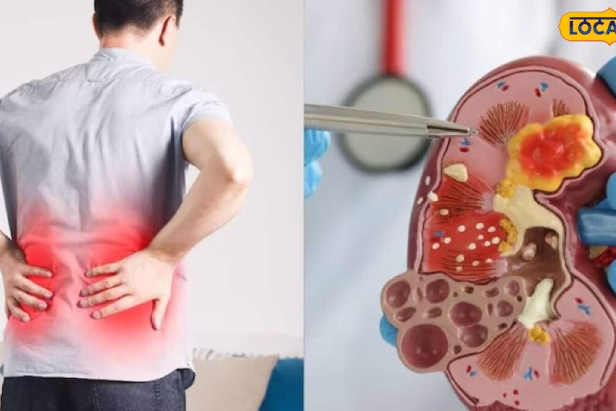 অজান্তেই পচছে কিডনি, জানান দেয় শরীর! যদি শরীরে 'এই' লক্ষণ দেখেন, তাহলে ডাক্তারের কাছে যান অজান্তেই পচছে কিডনি, জানান দেয় শরীর! যদি শরীরে 'এই' লক্ষণ দেখেন, তাহলে ডাক্তারের কাছে যান