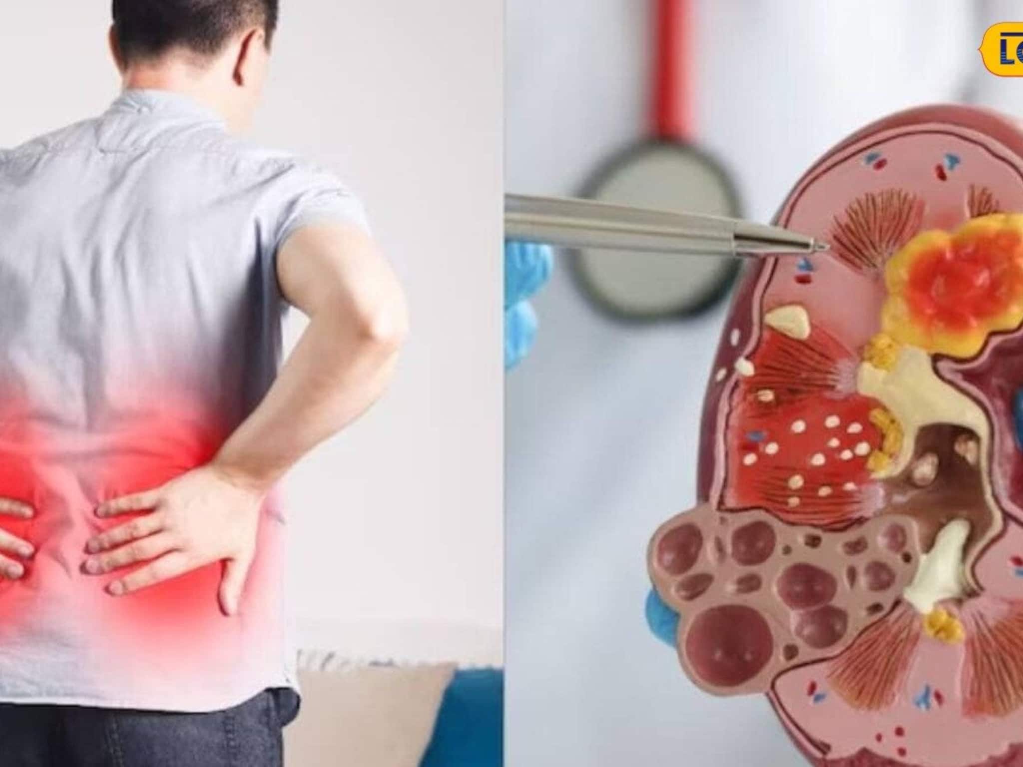 অজান্তেই পচছে কিডনি, জানান দেয় শরীর! যদি শরীরে 'এই' লক্ষণ দেখেন, তাহলে ডাক্তারের কাছে যান অজান্তেই পচছে কিডনি, জানান দেয় শরীর! যদি শরীরে 'এই' লক্ষণ দেখেন, তাহলে ডাক্তারের কাছে যান