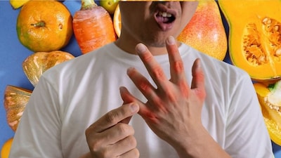 ইউরিক অ্যাসিড 