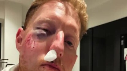 বেন স্টোকসের মুখে ভয়াবহ আঘাত Photo Courtesy- Instagram বেন স্টোকসের মুখে ভয়াবহ আঘাত Photo Courtesy- Instagram