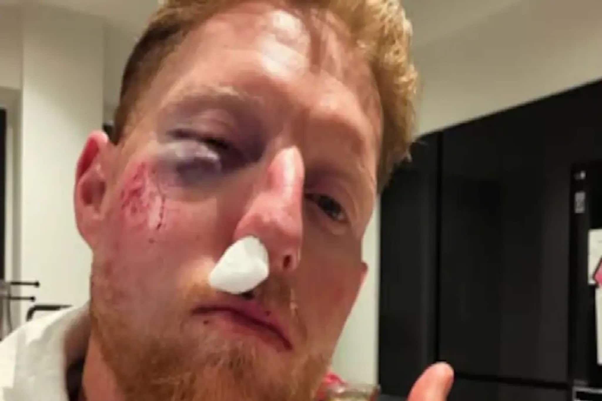 চোখের নিচে ভয়ানক কালশিটে,নাকের নিচে রক্ত থামানো হয়েছে তুলো গুঁজে,বেন স্টোকসের ভয়ানক হাল