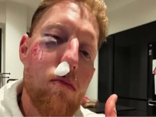 বেন স্টোকসের মুখে ভয়াবহ আঘাত Photo Courtesy- Instagram 