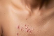 Detect Skin Cancer: ত্বকে 'এমন' দাগ দেখলে সাবধান...! ত্বকের ক্যানসার হতে পারে, কোন কোন লক্ষণ প্রাণঘাতী? জানুন