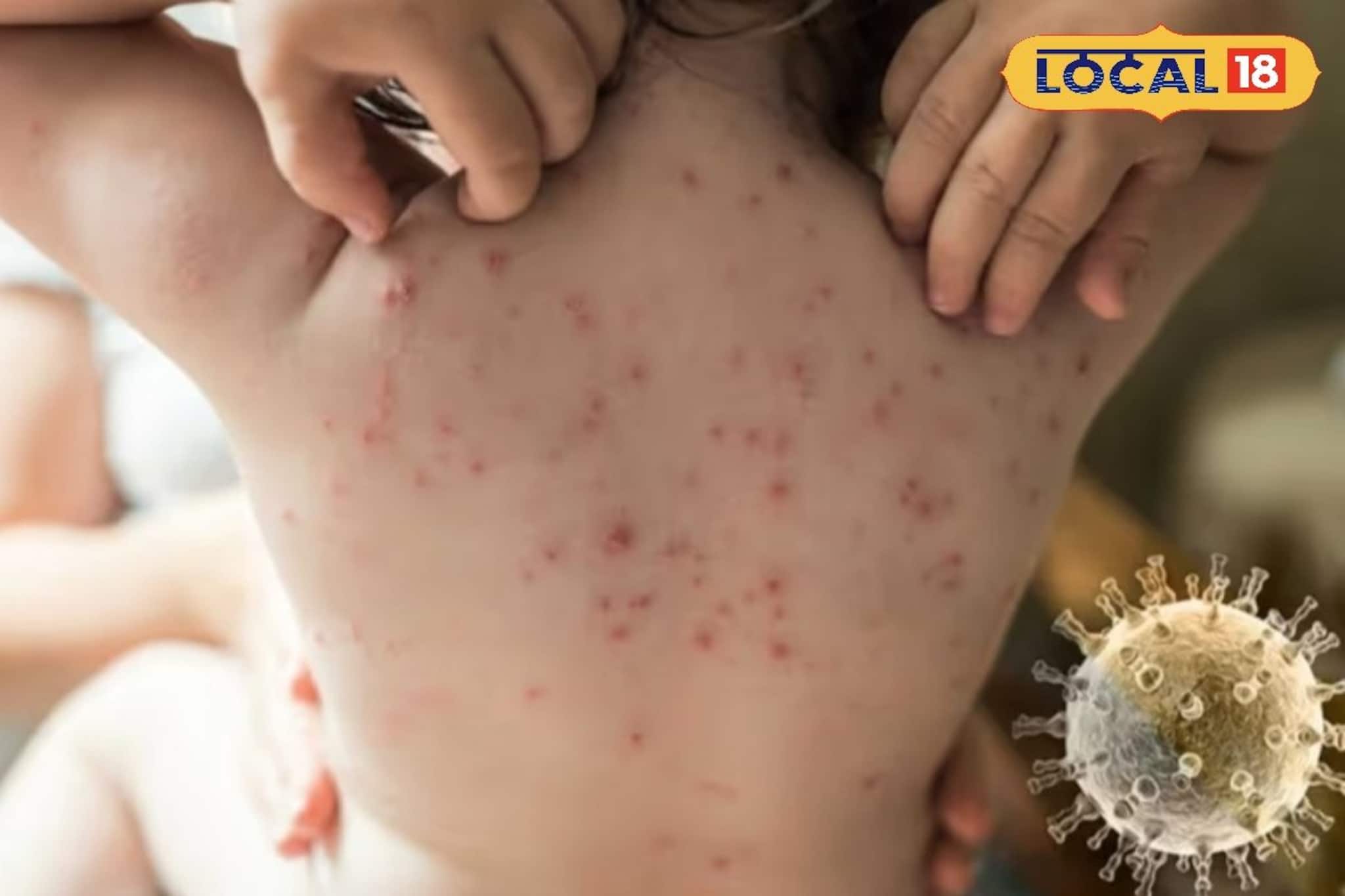 বসন্তের হাওয়ায় পক্সের আতঙ্ক? শরীরকে লোহার মতো শক্ত করতে ডায়েটে রাখতেই হবে ৫ খাবার