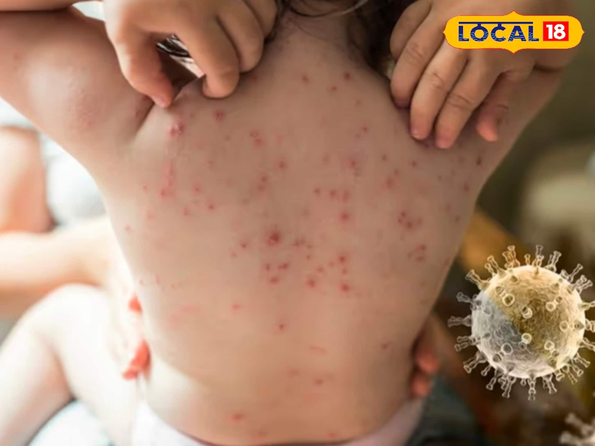 বসন্তের হাওয়ায় পক্সের আতঙ্ক? শরীরকে লোহার মতো শক্ত করতে ডায়েটে রাখতেই হবে ৫ খাবার