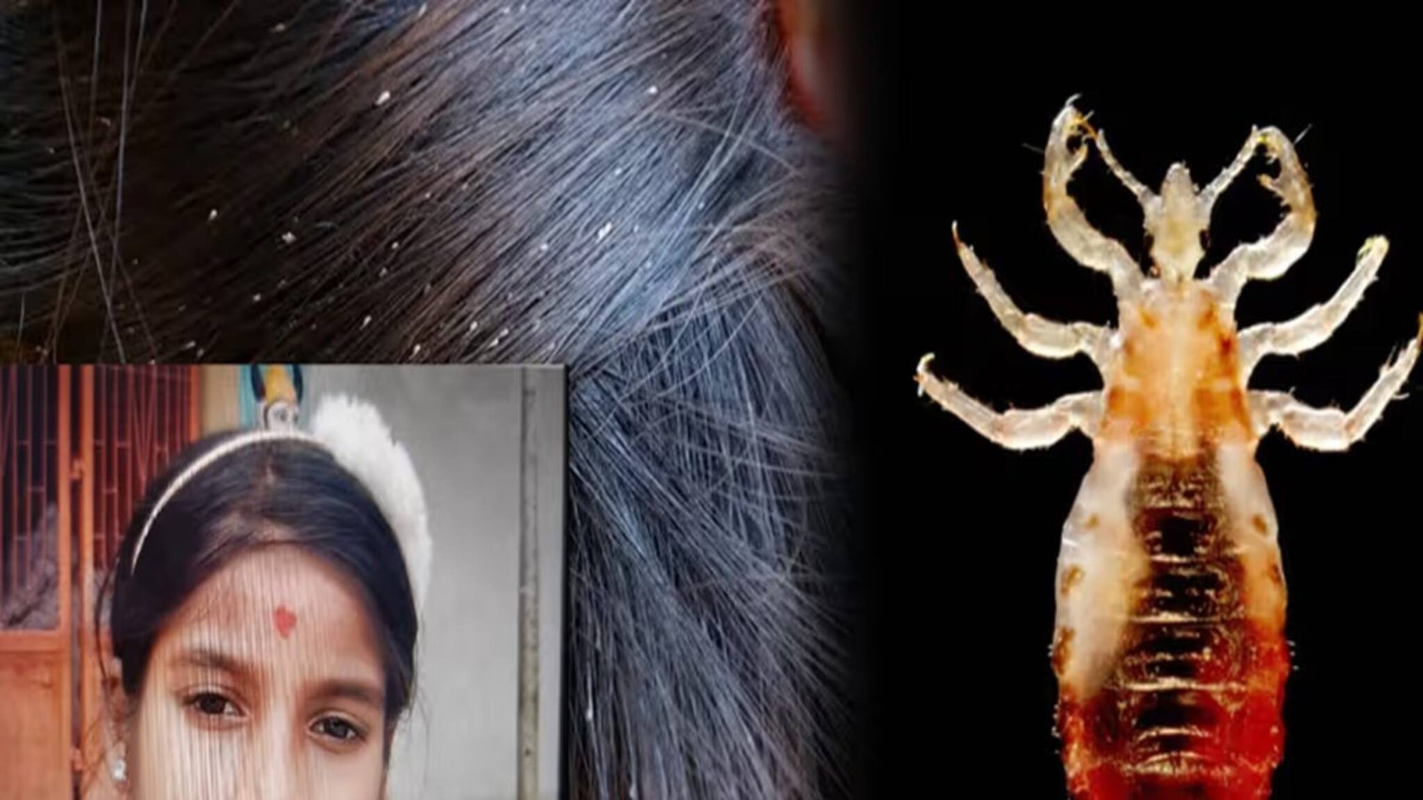 Lice: মাথায় উকুন ছোট্ট মেয়ের, সেখান থেকেই মৃত্যু! ভাবতে পারছেন! কী ভয়াবহ ঘটনা পুরীতে! যা ঘটল, শুনে আঁতকে উঠবেন
