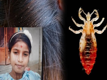 মাথায় উকুন ছোট্ট মেয়ের, সেখান থেকেই মৃত্যু! ভাবতে পারছেন! কী ভয়াবহ ঘটনা পুরীতে! যা ঘটল...