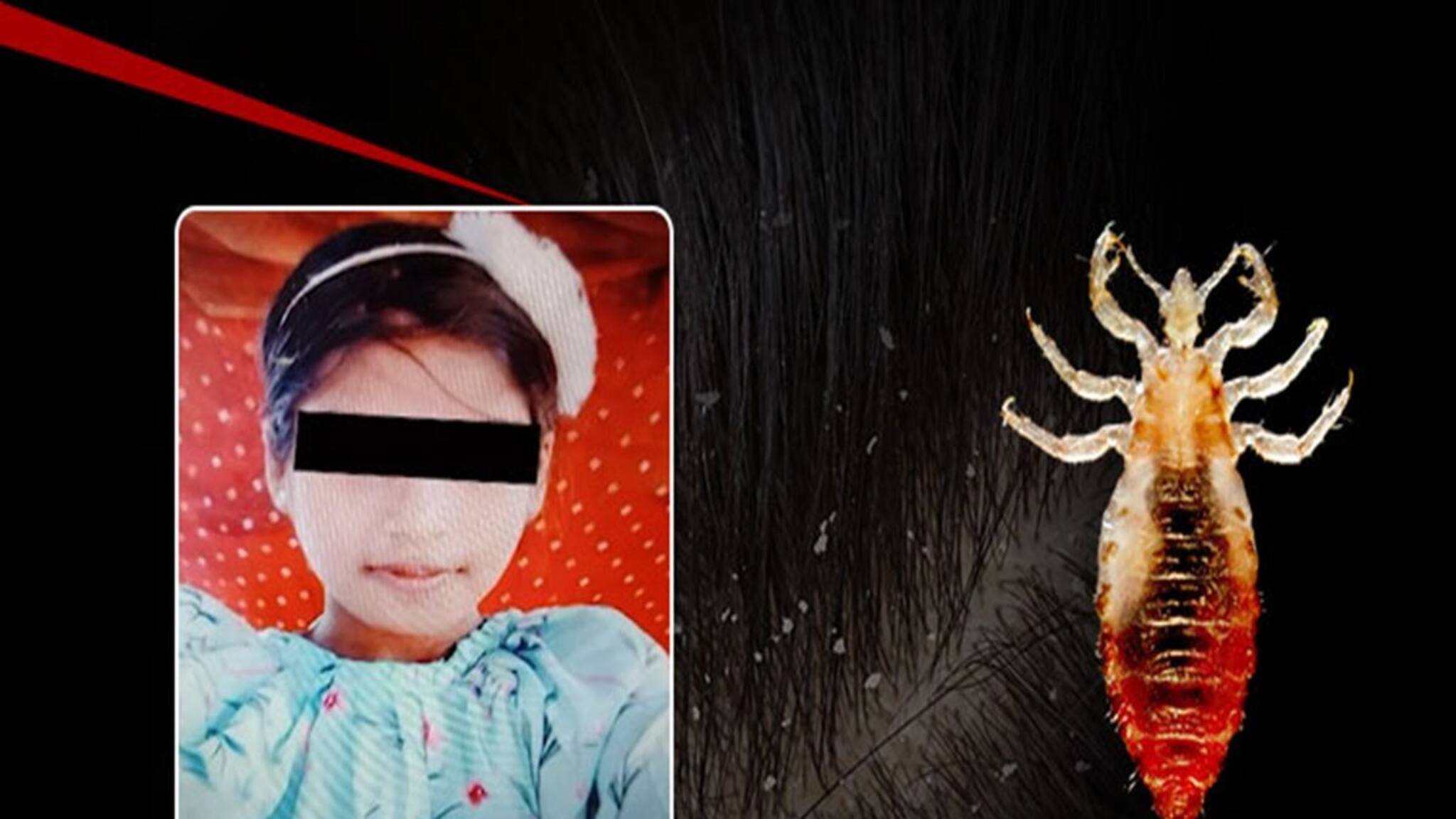 Lice Kill Girl: উকুন থেকে মৃত্যু! কতটা ভয়াবহ হতে পারে মাথায় উকুন, বুঝিয়ে গেল ওড়িশার ছোট্ট মেয়ে! কখন উকুন থেকে মৃত্যু হতে পারে জানেন!
