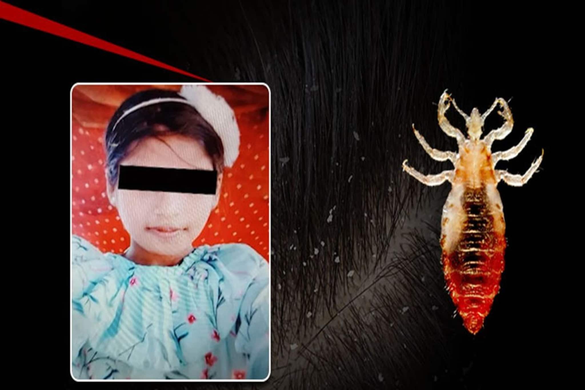 উকুন থেকে মৃত্যু! কতটা ভয়াবহ উকুন, বুঝিয়ে গেল ওড়িশার ছোট্ট মেয়ে! কখন উকুন প্রাণঘাতী জানেন