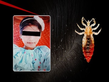 উকুন থেকে মৃত্যু! কতটা ভয়াবহ উকুন, বুঝিয়ে গেল ওড়িশার ছোট্ট মেয়ে! কখন উকুন প্রাণঘাতী জানেন