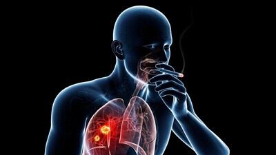 ক্রমেই মহামারির আকার নিচ্ছে মারণ রোগ ক্যানসার। গোটা দেশে ভয়ঙ্কর হারে বেড়েছে লাং ক্যানসার বা ফুসফুস ক্যানসারে আক্রান্তের সংখ্যা। বিশ্ব স্বাস্থ্য সংস্থার (WHO) মতে, ফুসফুস ক্যানসার বিশ্বজুড়ে ক্যানসারজনিত মৃত্যুর প্রধান কারণ, যা পুরুষ ও মহিলাদের মধ্যে সর্বোচ্চ মৃত্যুহারের জন্য দায়ী।