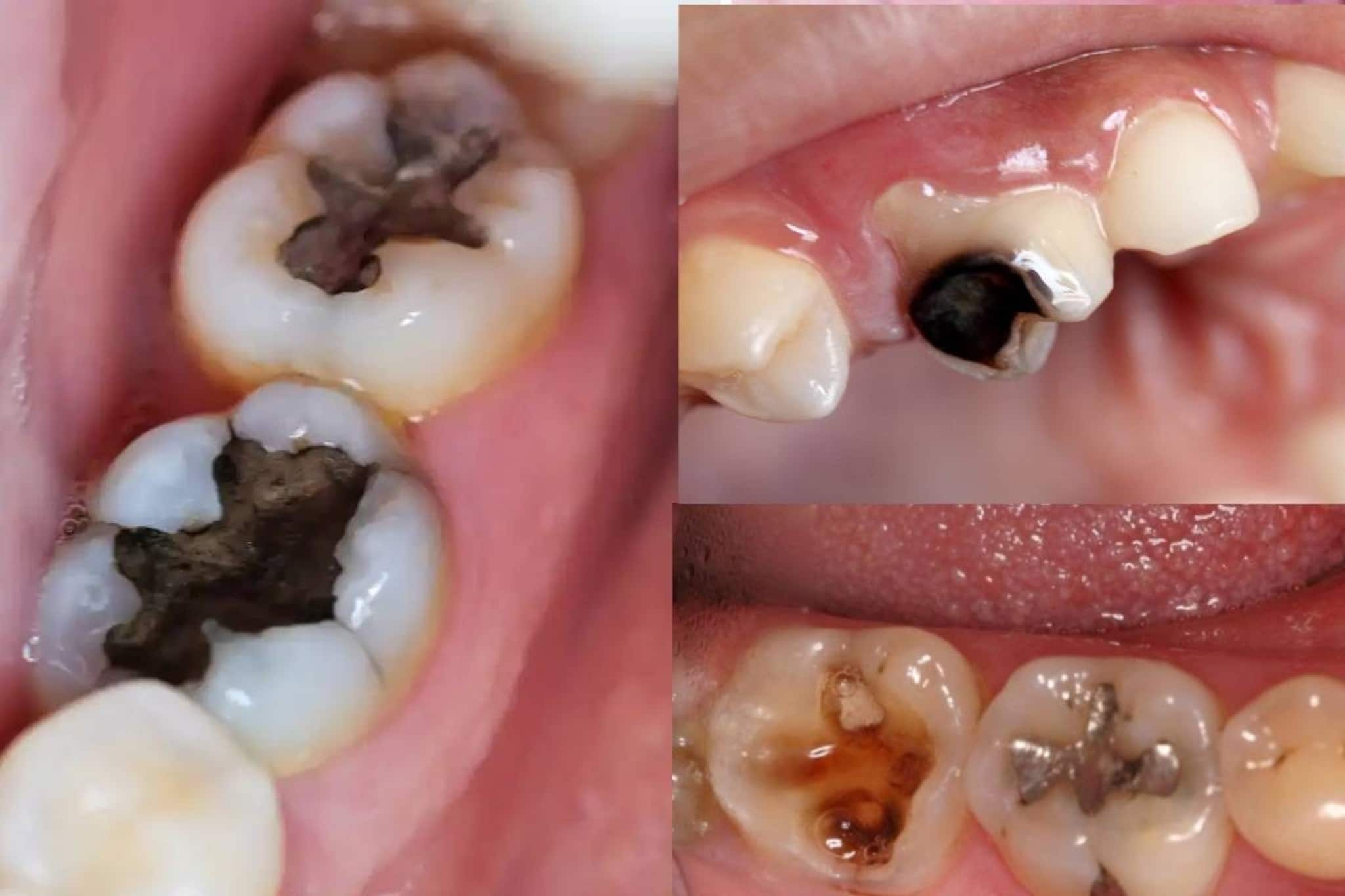 সরষের তেলে এটা জাস্ট ১ চিমটি! মিশিয়ে দাঁতের কালো গর্তে দিলেই কমবে যন্ত্রণা, পাবেন আরাম