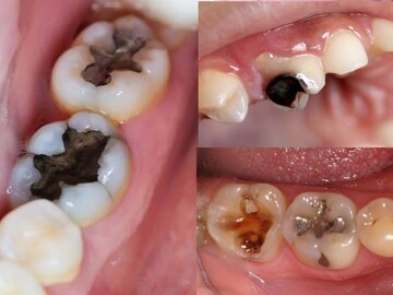 সরষের তেলে এটা জাস্ট ১ চিমটি! মিশিয়ে দাঁতের কালো গর্তে দিলেই কমবে যন্ত্রণা, পাবেন আরাম